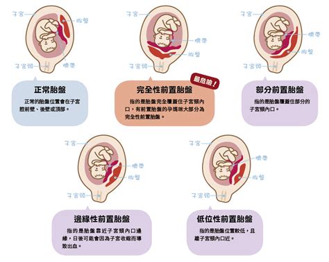 胎盤位置會變嗎